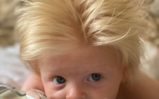 Due to a rare condition, the infant resembles Boris Johnson because her hair cannot be combed.