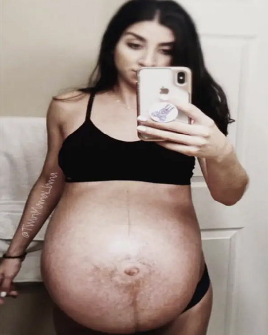 Following the birth of her twins, the mother's stomach appeared pregnant.